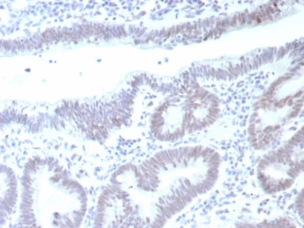 Formalin-fixed, paraffin-embedded human colon carcinoma stained with p53 Recombinant Mouse Monoclonal Antibody (rTP53/8993). HIER: Tris/EDTA, pH9.0, 45min. 2°C: HRP-polymer, 30min. DAB, 5min.