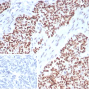 Formalin-fixed, paraffin-embedded human ovarian carcinoma stained with p53 Recombinant Rabbit Monoclonal Antibody (TP53/7082R). Inset: PBS instead of primary antibody; secondary only negative control.