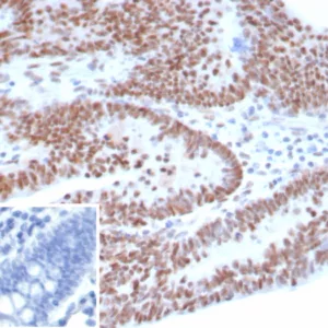 Formalin-fixed, paraffin-embedded human ovarian carcinoma stained with p53 Recombinant Rabbit Monoclonal Antibody (TP53/8183R). Inset: PBS instead of primary antibody; secondary only negative control.