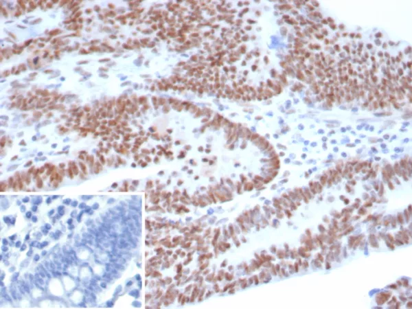 Formalin-fixed, paraffin-embedded human ovarian carcinoma stained with p53 Recombinant Rabbit Monoclonal Antibody (TP53/8183R). Inset: PBS instead of primary antibody; secondary only negative control.