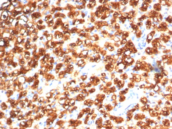 Formalin-fixed, paraffin-embedded human kidney cancer stained with TPH1 Mouse Monoclonal Antibody (TPH1/7662). HIER: Tris/EDTA, pH9.0, 45min. 2°C: HRP-polymer, 30min. DAB, 5min.