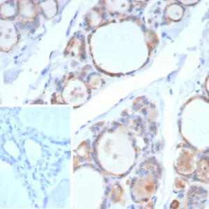 Formalin-fixed, paraffin-embedded human thyroid carcinoma stained with Thyroid Peroxidase Recombinant Mouse Monoclonal Antibody (rTPO/7248). Inset: PBS instead of primary antibody; secondary only negative control.