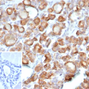 Formalin-fixed, paraffin-embedded human thyroid carcinoma stained with Thyroid Peroxidase Recombinant Rabbit Monoclonal Antibody (TPO/7088R). Inset: PBS instead of primary antibody; secondary only negative control.