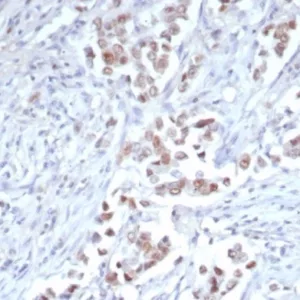 IHC analysis of formalin-fixed, paraffin-embedded human breast carcinoma.  Strong nuclear staining using TRPS1/7912R at 2ug/ml in PBS for 30min RT. HIER: Tris/EDTA, pH9.0, 45min. 2°C: HRP-polymer, 30min. DAB, 5min.