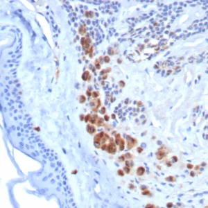 Formalin-fixed, paraffin-embedded human melanoma stained with TYRP1 Rabbit Recombinant Monoclonal Antibody (TYRP1/8313R). HIER: Tris/EDTA, pH9.0, 45min. 2°C: HRP-polymer, 30min. DAB, 5min.