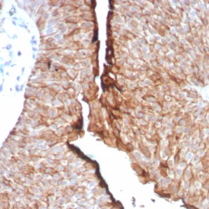Formalin-fixed, paraffin-embedded human urothelial carcinoma stained with Uroplakin 1B Recombinant Rabbit Monoclonal Antibody (UPK1B/8976R). HIER: Tris/EDTA, pH9.0, 45min. 2°C: HRP-polymer, 30min. DAB, 5min.