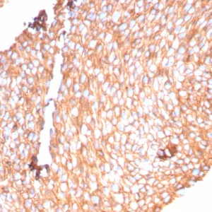 Formalin-fixed, paraffin-embedded human bladder carcinoma stained with Uroplakin 1B Recombinant Rabbit Monoclonal Antibody (UPK1B/9258R). HIER: Tris/EDTA, pH9.0, 45min. 2°C: HRP-polymer, 30min. DAB, 5min.