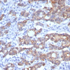 Formalin-fixed, paraffin-embedded human colon adenocarcinoma stained with Villin Recombinant Mouse Monoclonal Antibody (rVIL1/8336). HIER: Tris/EDTA, pH9.0, 45min. 2°C: HRP-polymer, 30min. DAB, 5min.
