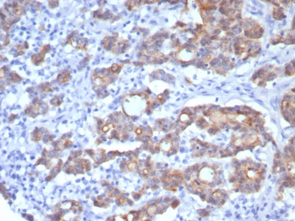 Formalin-fixed, paraffin-embedded human colon adenocarcinoma stained with Villin Recombinant Mouse Monoclonal Antibody (rVIL1/8336). HIER: Tris/EDTA, pH9.0, 45min. 2°C: HRP-polymer, 30min. DAB, 5min.