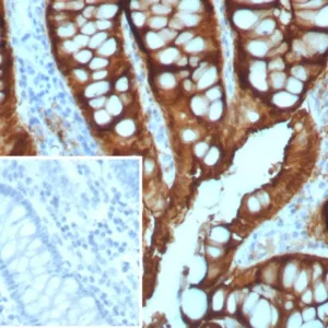 Formalin-fixed, paraffin-embedded human colon adenocarcinoma stained with Villin Recombinant Rabbit Monoclonal Antibody (VIL1/7378R). Inset: PBS instead of primary antibody; secondary only negative control.