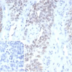 Formalin-fixed, paraffin-embedded human ovarian carcinoma stained with Wilm&apos;s Tumor Mouse Monoclonal Antibody (WT1/7450). Inset: PBS instead of primary antibody; secondary only negative control.