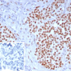 Formalin-fixed, paraffin-embedded human ovarian carcinoma stained with Wilm&apos;s Tumor Mouse Monoclonal Antibody (WT1/7715). Inset: PBS instead of primary antibody; secondary only negative control.