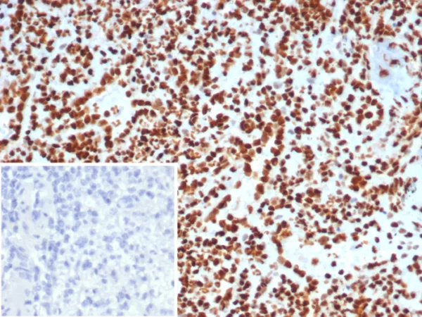 Formalin-fixed, paraffin-embedded human lymph node stained with XRCC5 / Ku86 / Ku80 Mouse Monoclonal Antibody (XRCC5/7313). Inset: PBS instead of primary antibody; secondary only negative control.