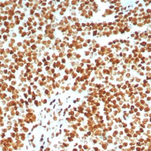 Formalin-fixed, paraffin-embedded human lymph node stained with Ku80 Recombinant Rabbit Monoclonal Antibody (XRCC5/8093R). HIER: Tris/EDTA, pH9.0, 45min. 2°C: HRP-polymer, 30min. DAB, 5min.