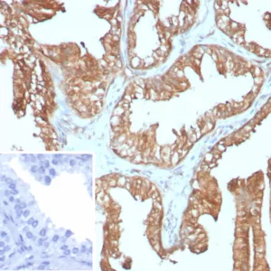 Formalin-fixed, paraffin-embedded human prostate carcinoma stained with 14-3-3E Recombinant Mouse Monoclonal Antibody (rYWHAE/8860). HIER: Tris/EDTA, pH9.0, 45min. 2°C: HRP-polymer, 30min. DAB, 5min.