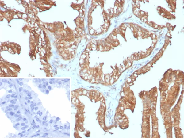 Formalin-fixed, paraffin-embedded human prostate carcinoma stained with 14-3-3E Recombinant Mouse Monoclonal Antibody (rYWHAE/8860). HIER: Tris/EDTA, pH9.0, 45min. 2°C: HRP-polymer, 30min. DAB, 5min.