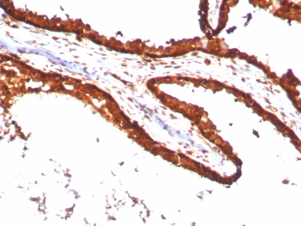 Formalin-fixed, paraffin-embedded human prostate carcinoma stained with 14-3-3E Recombinant Rabbit Monoclonal Antibody (YWHAE/8636R). HIER: Tris/EDTA, pH9.0, 45min. 2°C: HRP-polymer, 30min. DAB, 5min.
