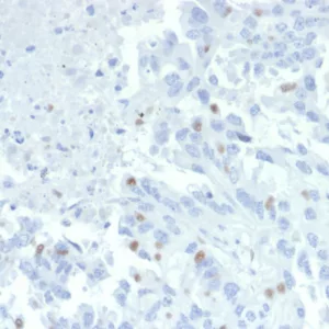 Formalin-fixed, paraffin-embedded human tumor of unknown origin stained with ZNF232 Mouse Monoclonal Antibody (PCRP-ZNF232-2B3). HIER: Tris/EDTA, pH9.0, 45min. 2°C: HRP-polymer, 30min. DAB, 5min.
