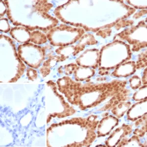 Formalin-fixed, paraffin-embedded human thyroid stained with PAX8 Recombinant Rabbit Monoclonal Antibody (PAX8/6848R). HIER: Tris/EDTA, pH9.0, 45min. 2°C: HRP-polymer, 30min. DAB, 5min.