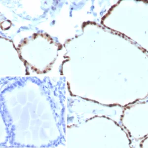 Formalin-fixed, paraffin-embedded human thyroid stained with PAX8 Recombinant Rabbit Monoclonal Antibody (PAX8/8973R). HIER: Tris/EDTA, pH9.0, 45min. 2°C: HRP-polymer, 30min. DAB, 5min.