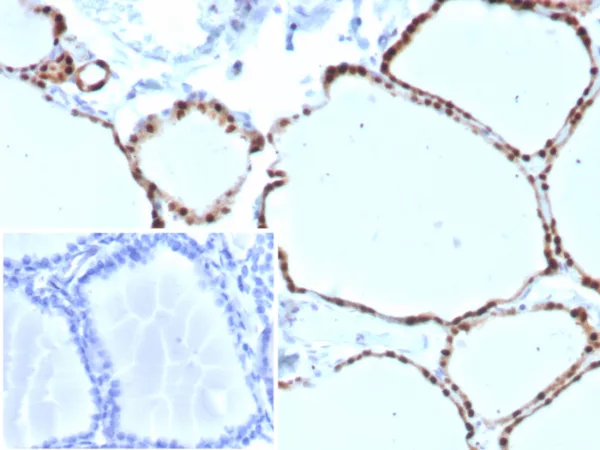 Formalin-fixed, paraffin-embedded human thyroid stained with PAX8 Recombinant Rabbit Monoclonal Antibody (PAX8/8973R). HIER: Tris/EDTA, pH9.0, 45min. 2°C: HRP-polymer, 30min. DAB, 5min.