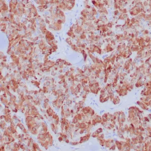Formalin-fixed, paraffin-embedded human medullary carcinoma stained with  Calcitonin Recombinant Rabbit Monoclonal Antibody (CALCA/8639R). HIER: Tris/EDTA, pH9.0, 45min. 2°C: HRP-polymer, 30min. DAB, 5min.
