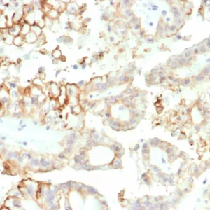 Formalin-fixed, paraffin-embedded human kidney carcinoma stained with CD276 / B7-H3 Mouse Monoclonal Antibody (B7H3/4313) at 2ug/ml. HIER: Tris/EDTA, pH9.0, 45min. 2°C: HRP-polymer, 30min. DAB, 5min.