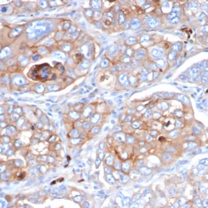 Formalin-fixed, paraffin-embedded human lung cancer stained with CD276 / B7-H3 Mouse Monoclonal Antibody (B7H3/4479) at 2ug/ml. HIER: Tris/EDTA, pH9.0, 45min. 2°C: HRP-polymer, 30min. DAB, 5min.