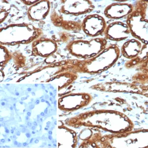 Formalin-fixed, paraffin-embedded human renal cell carcinoma stained with Calnexin Recombinant Rabbit Monoclonal Antibody (CANX/9147R). HIER: Tris/EDTA, pH9.0, 45min. 2°C: HRP-polymer, 30min. DAB, 5min.