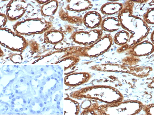 Formalin-fixed, paraffin-embedded human renal cell carcinoma stained with Calnexin Recombinant Rabbit Monoclonal Antibody (CANX/9147R). HIER: Tris/EDTA, pH9.0, 45min. 2°C: HRP-polymer, 30min. DAB, 5min.