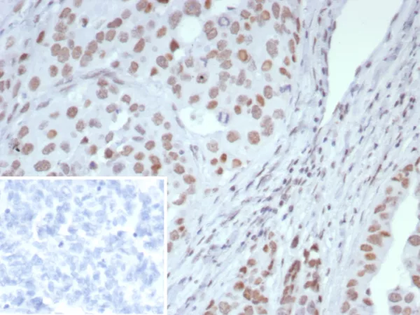 Formalin-fixed, paraffin-embedded human ovarian cancer stained with ARID1A Mouse Monoclonal Antibody (ARID1A/7735). Inset: PBS instead of primary antibody; secondary only negative control.