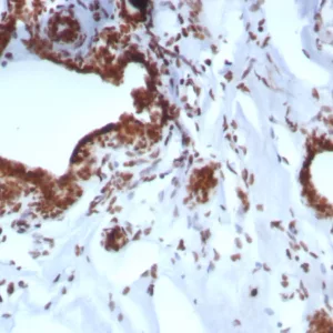Formalin-fixed, paraffin-embedded human breast carcinoma stained with BAP1 Recombinant Rabbit Monoclonal Antibody (BAP1/8959R). HIER: Tris/EDTA, pH9.0, 45min. 2°C: HRP-polymer, 30min. DAB, 5min.