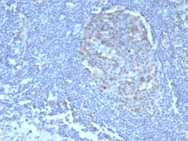 Formalin-fixed, paraffin-embedded human tonsil stained with Caspase 3 Mouse Monoclonal Antibody (CASP3/8446). HIER: Tris/EDTA, pH9.0, 45min. 2°C: HRP-polymer, 30min. DAB, 5min.