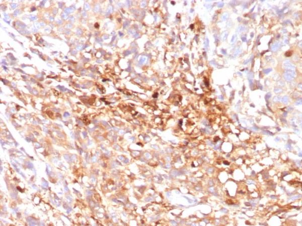 Formalin-fixed, paraffin-embedded human triple negative breast cancer stained with ABCC11 Mouse Monoclonal Antibody (ABCC11/2438). HIER: Tris/EDTA, pH9.0, 45min. 2°C: HRP-polymer, 30min. DAB, 5min.
