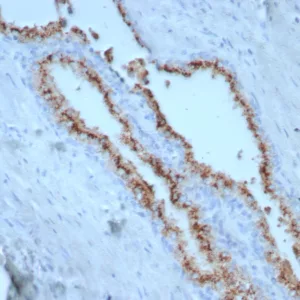 Formalin-fixed, paraffin-embedded human prostate stained with Prostein (p501S) Mouse Monoclonal Antibody (SLC45A3/7650). HIER: Tris/EDTA, pH9.0, 45min. 2°C: HRP-polymer, 30min. DAB, 5min.