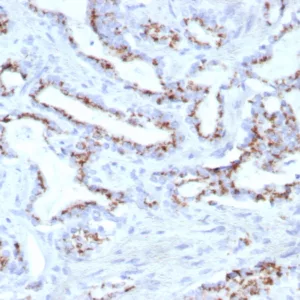 Formalin-fixed, paraffin-embedded human prostate stained with Prostein (p501S) Mouse Monoclonal Antibody (SLC45A3/7653). HIER: Tris/EDTA, pH9.0, 45min. 2°C: HRP-polymer, 30min. DAB, 5min.