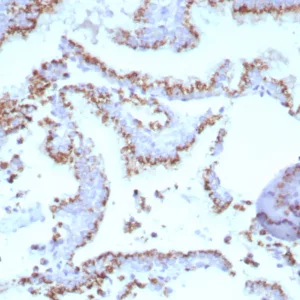 Formalin-fixed, paraffin-embedded human prostate stained with Prostein (p501S) Mouse Monoclonal Antibody (SLC45A3/7647). HIER: Tris/EDTA, pH9.0, 45min. 2°C: HRP-polymer, 30min. DAB, 5min.