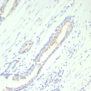 Formalin-fixed, paraffin-embedded human prostate stained with Prostein Recombinant Rabbit Monoclonal Antibody (SLC45A3/9216R). HIER: Tris/EDTA, pH9.0, 45min. 2°C: HRP-polymer, 30min. DAB, 5min.