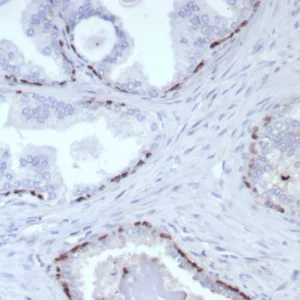 Formalin-fixed, paraffin-embedded human prostate cancer stained with  p63 Recombinant Mouse Monoclonal Antibody (rP40/8765). HIER: Tris/EDTA, pH9.0, 45min. 2°C: HRP-polymer, 30min. DAB, 5min.
