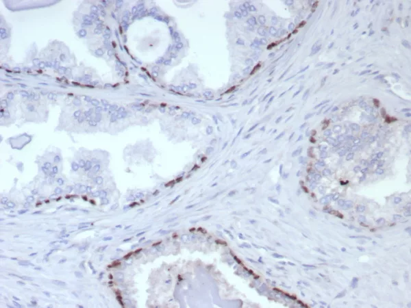 Formalin-fixed, paraffin-embedded human prostate cancer stained with  p63 Recombinant Mouse Monoclonal Antibody (rP40/8765). HIER: Tris/EDTA, pH9.0, 45min. 2°C: HRP-polymer, 30min. DAB, 5min.