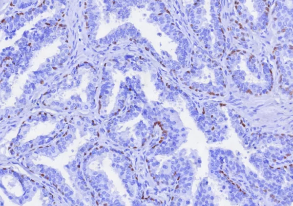 Formalin-fixed, paraffin-embedded human prostate cancer stained with  p63 Recombinant Rabbit Monoclonal Antibody (TP63/7807R). HIER: Tris/EDTA, pH9.0, 45min. 2: HRP-polymer, 30min. DAB, 5min.