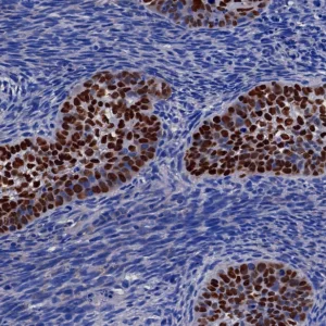 Formalin-fixed, paraffin-embedded human lung carcinoma stained with  p40 Recombinant Rabbit Monoclonal Antibody (P40/8225R). HIER: Tris/EDTA, pH9.0, 45min. 2: HRP-polymer, 30min. DAB, 5min.