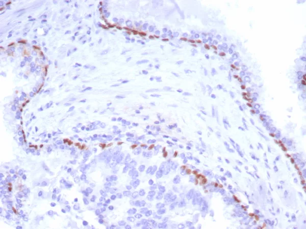 Formalin-fixed, paraffin-embedded human prostate carcinoma stained with  p40 Recombinant Rabbit Monoclonal Antibody (P40/8225R). HIER: Tris/EDTA, pH9.0, 45min. 2: HRP-polymer, 30min. DAB, 5min.