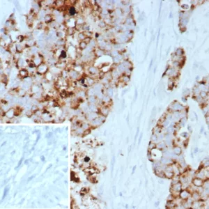 Formalin-fixed, paraffin-embedded human bladder carcinoma stained with GPRC5A Mouse Monoclonal Antibody (GPRC5A/7893). Inset: PBS instead of primary antibody; secondary only negative control.