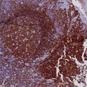 Formalin-fixed, paraffin-embedded human Tonsil stained with CD19 Mouse Monoclonal Antibody (CD19/7665). HIER: Tris/EDTA, pH9.0, 45min. 2°C: HRP-polymer, 30min. DAB, 5min.