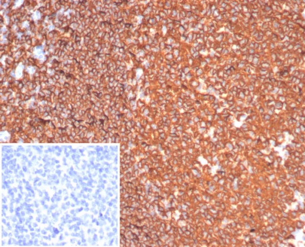 Formalin-fixed, paraffin-embedded human tonsil stained with CD20 Recombinant Rabbit Monoclonal Antibody (MS4A1/6993R). HIER: Tris/EDTA, pH9.0, 45min. 2°C: HRP-polymer, 30min. DAB, 5min.