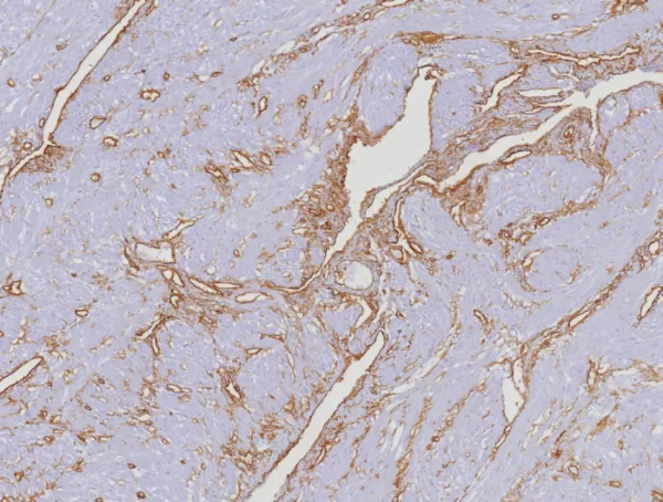 Formalin-fixed, paraffin-embedded human uterus stained with CD34 Rabbit Recombinant Monoclonal Antibody (HPCA1/8353R). HIER: Tris/EDTA, pH9.0, 45min. 2°C: HRP-polymer, 30min. DAB, 5min.