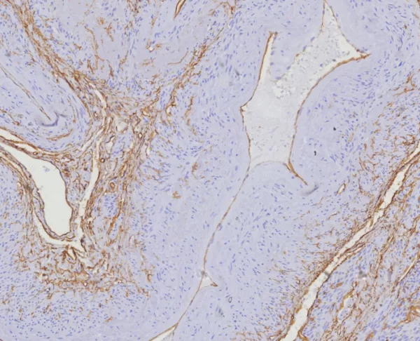 Formalin-fixed, paraffin-embedded human uterus stained with CD34 Rabbit Recombinant Monoclonal Antibody (HPCA1/8353R). HIER: Tris/EDTA, pH9.0, 45min. 2°C: HRP-polymer, 30min. DAB, 5min.