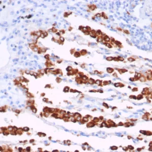 IHC analysis of formalin-fixed, paraffin-embedded human lung adenocarcinoma. rNAPSA/7239 at 2ug/ml in PBS for 30min RT. HIER: Tris/EDTA, pH9.0, 45min. 2°C: HRP-polymer, 30min. DAB, 5min