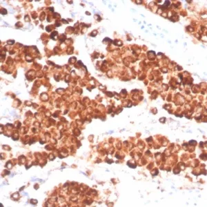 IHC analysis of formalin-fixed, paraffin-embedded human lung adenocarcinoma. NAPSA/7165R at 2ug/ml in PBS for 30min RT. HIER: Tris/EDTA, pH9.0, 45min. 2°C: HRP-polymer, 30min. DAB, 5min.